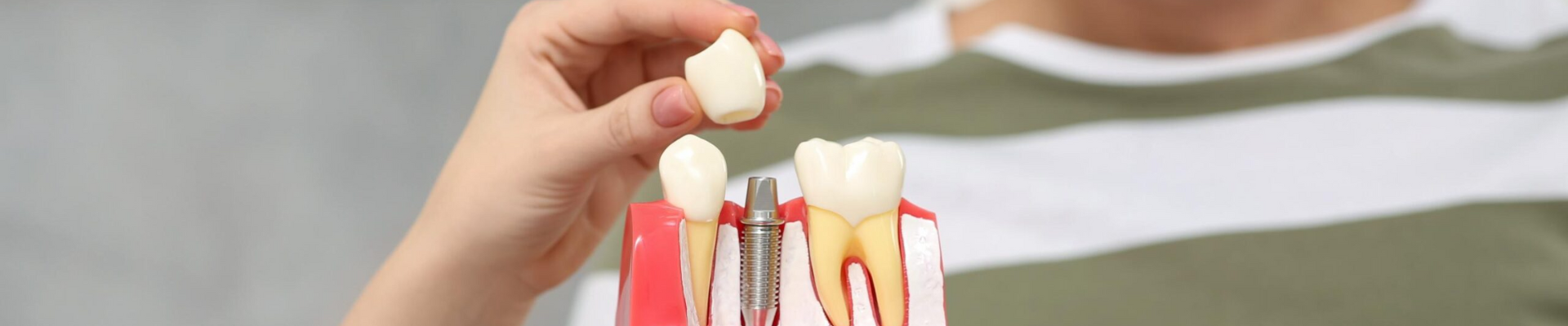 Implantes Dentales